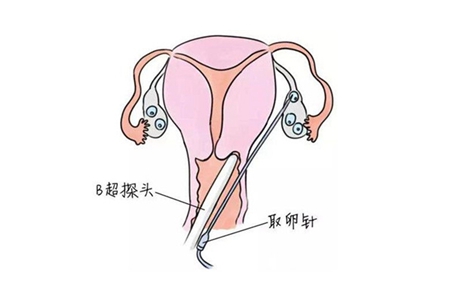 做供卵试管婴儿男方问题成功率高吗
